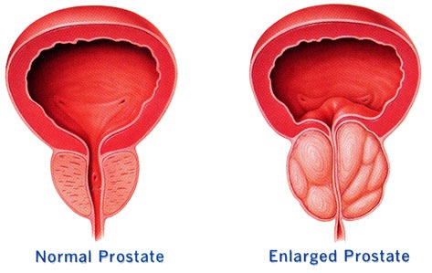 urinary kidney stone